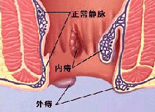 痔疮症状