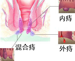 痔疮症状