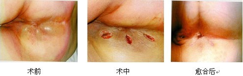 肛周脓肿手术