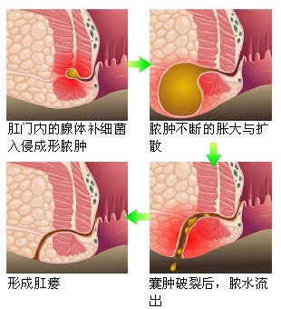 肛周脓肿形成肛瘘