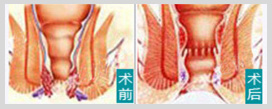 肛周术前术后对比