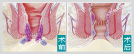 肛周术前术后对比