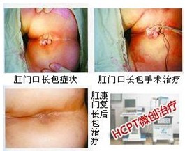 肛门异物治疗方法