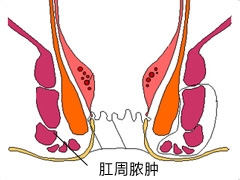 肛周脓肿