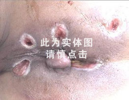 肛瘘