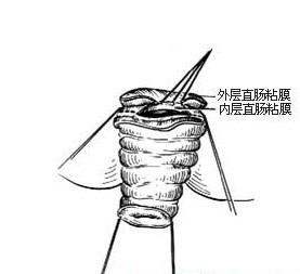 脱肛