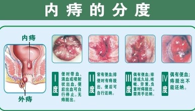 内痔