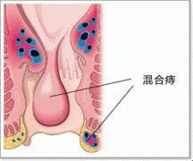 混合痔病理