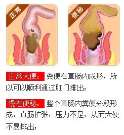 慢性便秘病因