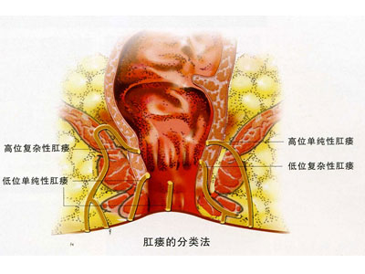 肛瘘