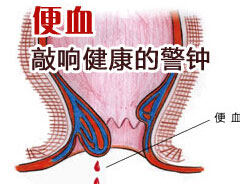 引起便血的原因