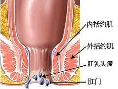 肛乳头瘤病因