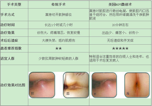 女性肛周脓肿怎么治疗