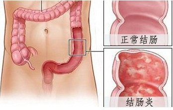 乙状结肠炎的症状