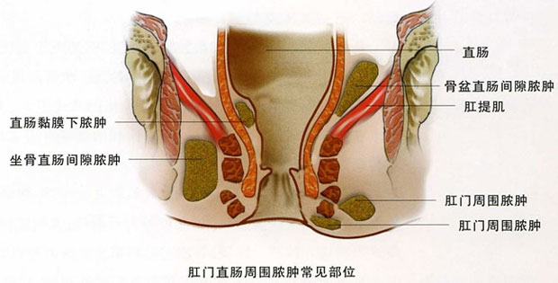 肛周脓肿