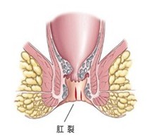 肛裂什么样子