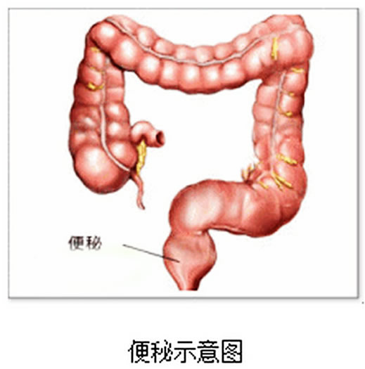 便秘危害