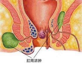 什么是肛周脓肿